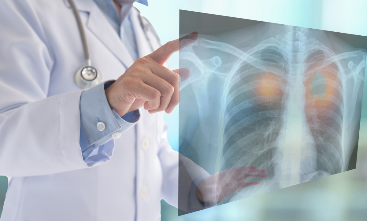 La contaminación del aire promueve el cáncer de pulmón en personas no fumadoras