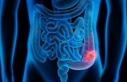 La obesidad y el sedentarismo aumentan el riesgo de cáncer colorrectal