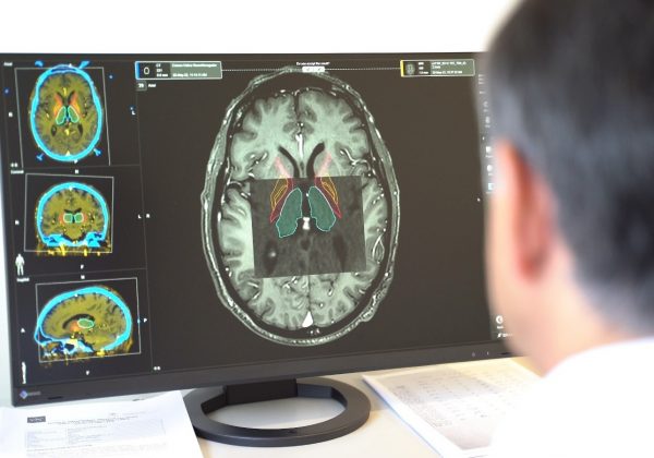 Nuevo hallazgo en fluidos corporales mejora el diagnóstico del Parkinson