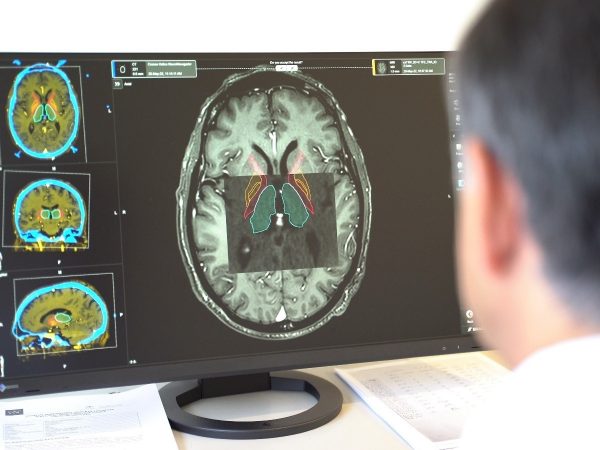 Nuevo hallazgo en fluidos corporales mejora el diagnóstico del Parkinson