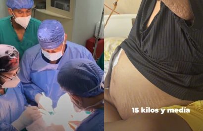 Una mujer vivía con un tumor de 30 libras, la neoplasia le fue extirpada a la paciente en un hospital del IESS en Guayaquil. (IESS)