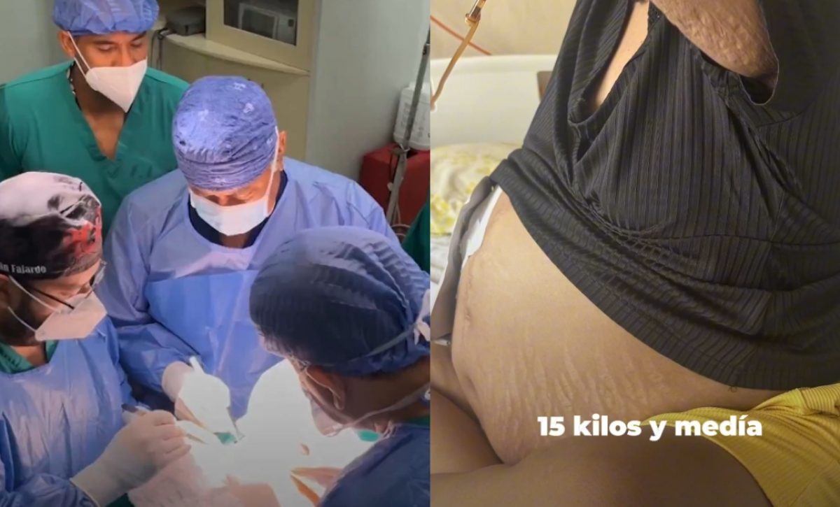 Una mujer vivía con un tumor de 30 libras, la neoplasia le fue extirpada a la paciente en un hospital del IESS en Guayaquil. (IESS)