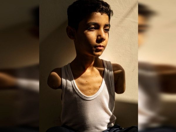 Fotografía de niño mutilado en Gaza gana el World Press Photo 2025
