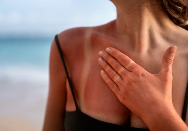 Alertan que broncearse daña la piel y eleva el riesgo de cáncer cutáneo