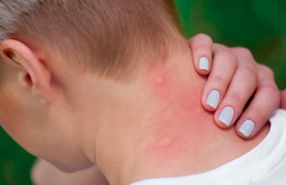 fiebre-amarilla-estos-son-los-sintomas-clave-para-su-deteccion-temprana