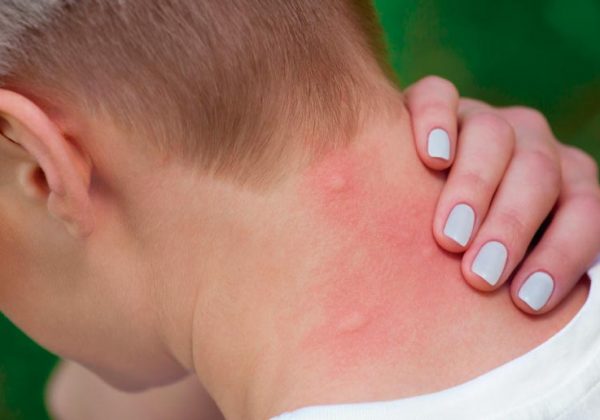 fiebre-amarilla-estos-son-los-sintomas-clave-para-su-deteccion-temprana