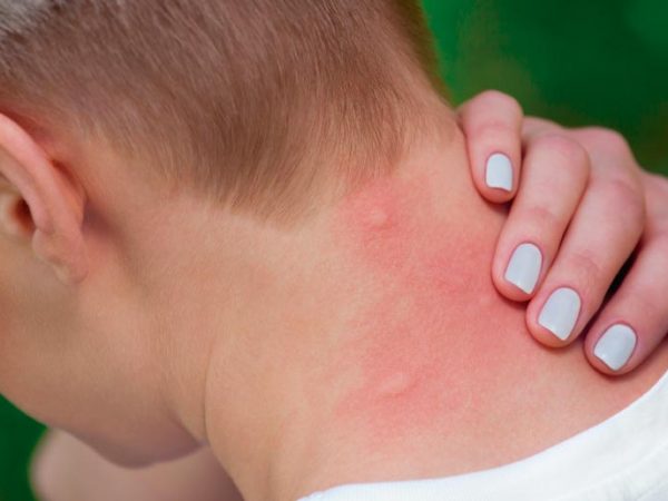 fiebre-amarilla-estos-son-los-sintomas-clave-para-su-deteccion-temprana