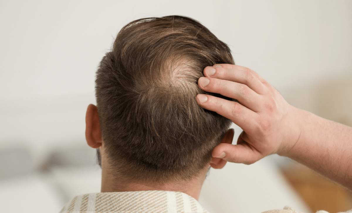 ¿Fin de la calvicie Descubren una molécula que impulsa el crecimiento del cabello